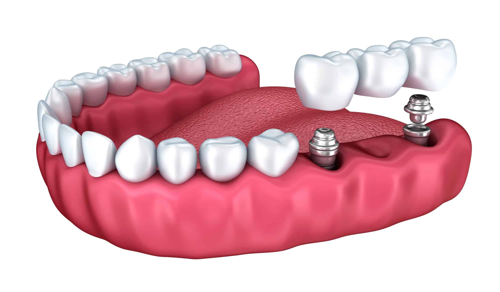 diagram of an implant supported dental bridge being installed