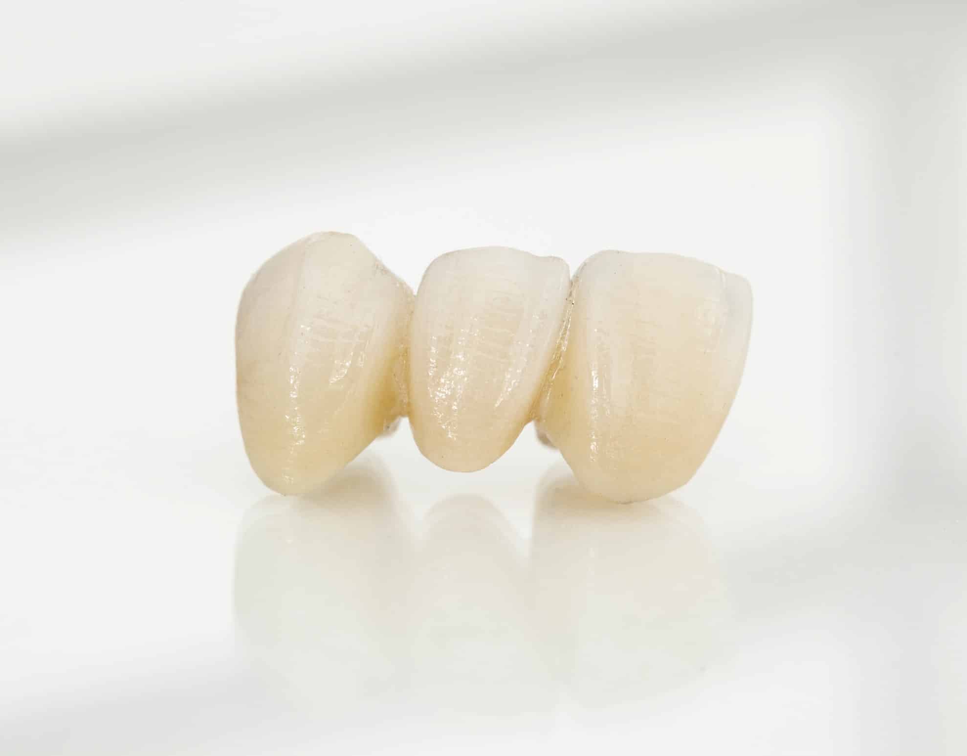 example of porcelain dental crowns