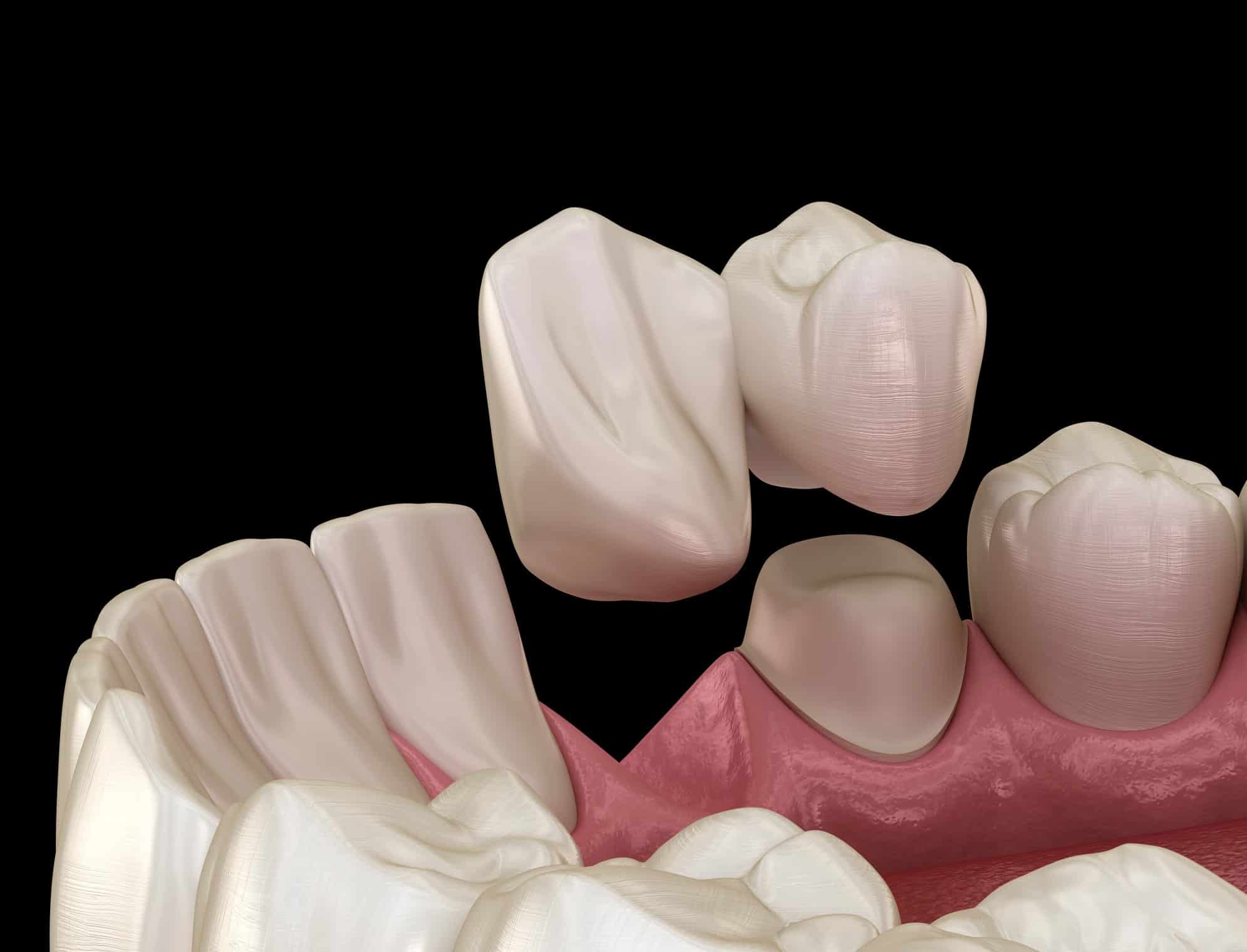 diagram of a cantilever dental bridge being installed