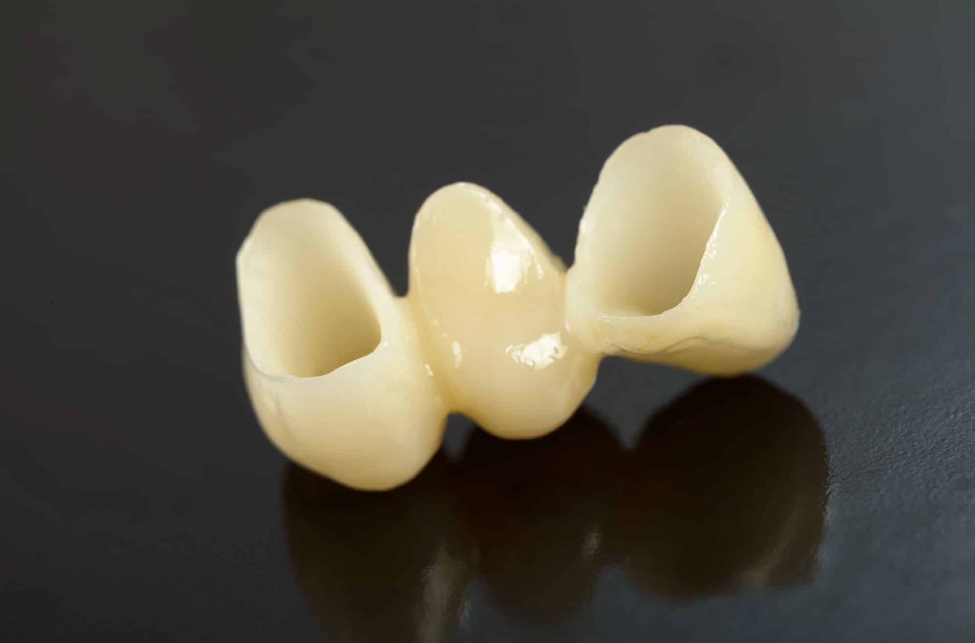 close up photo of a traditional fixed dental bridge sitting on a dark surface