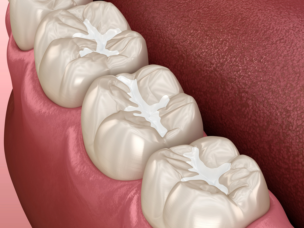 Inlay composite filling over tooth. Medically accurate 3D illustration of human teeth treatment