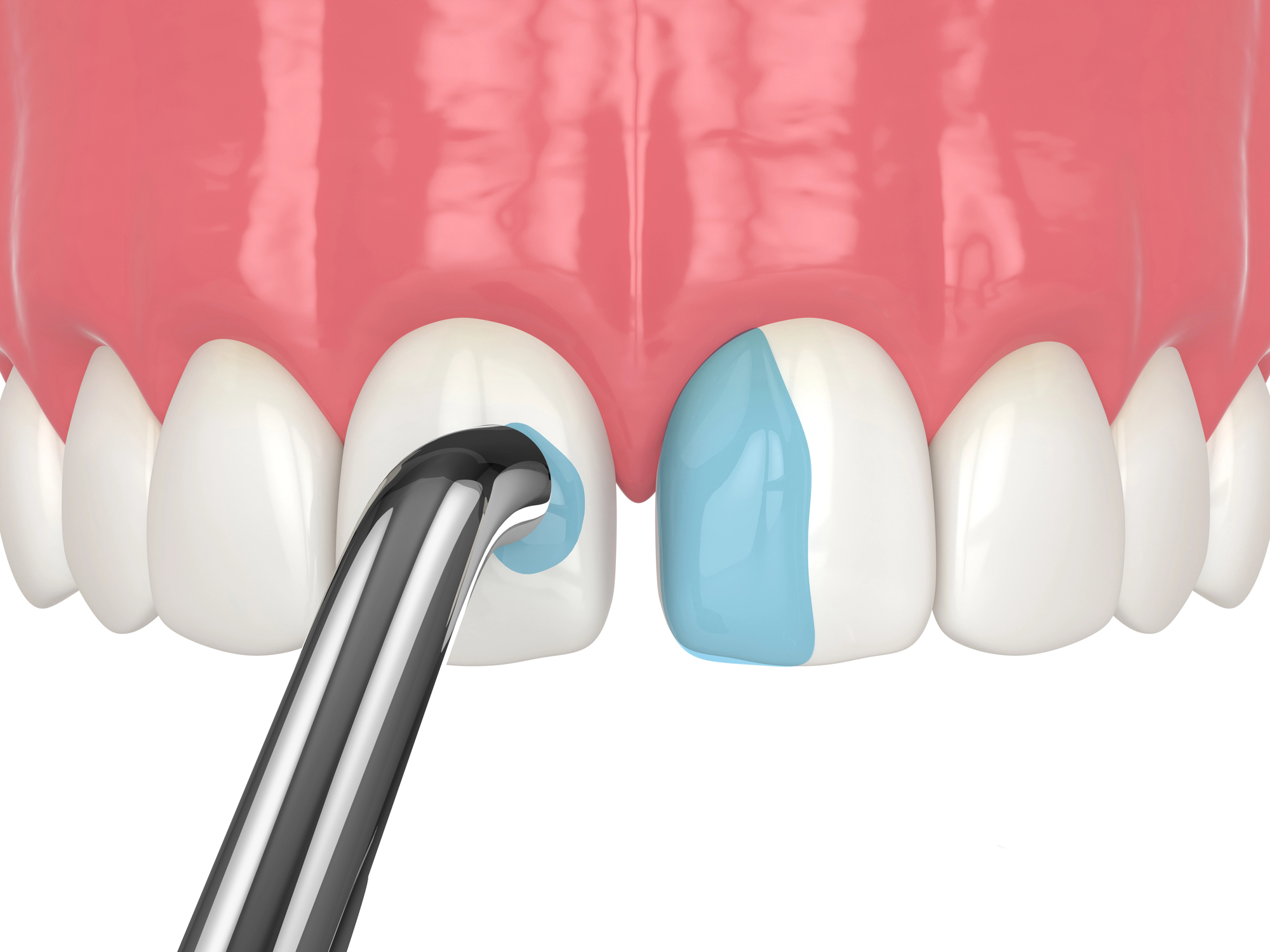 3d render of diastema closure using dental bonding procedure