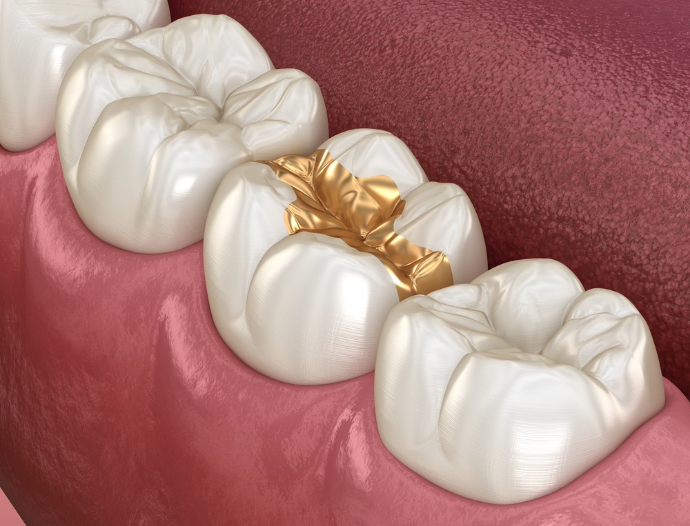 Inlay gold filling over tooth. Medically accurate 3D illustration of human teeth treatment