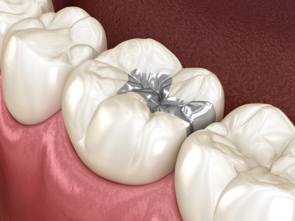 Inlay silver filling over tooth. Medically accurate 3D illustration of human teeth treatment